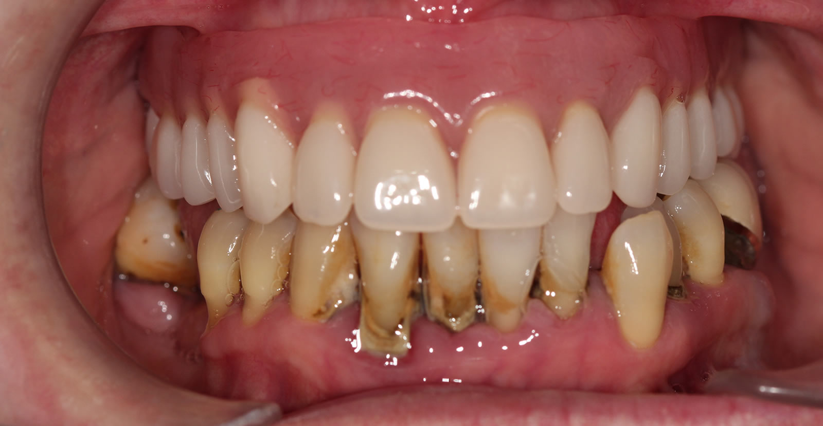 dental implant sachin sedani