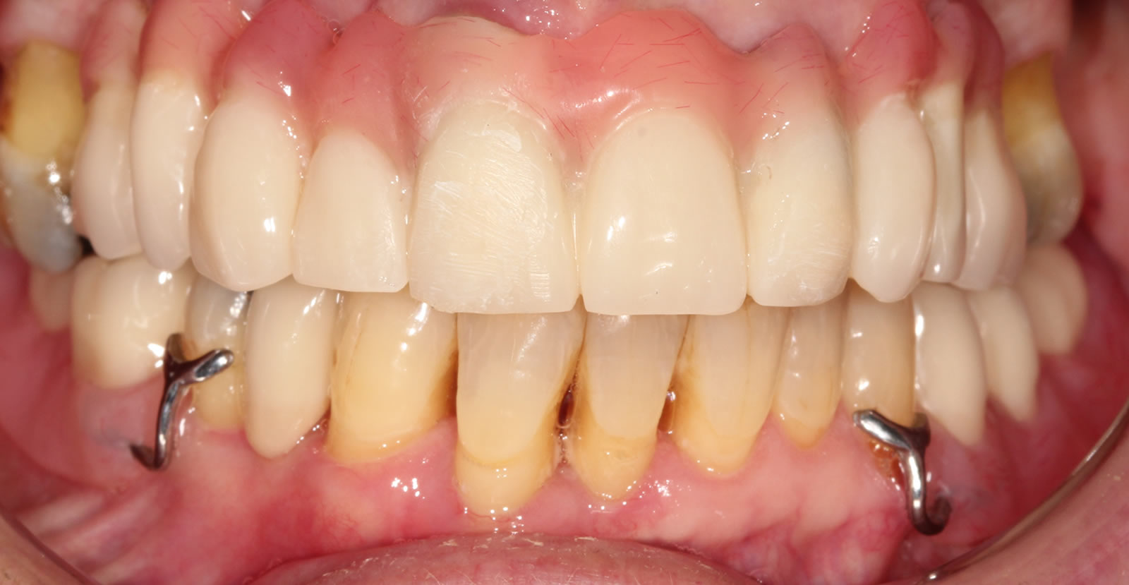 dental implant sachin sedani
