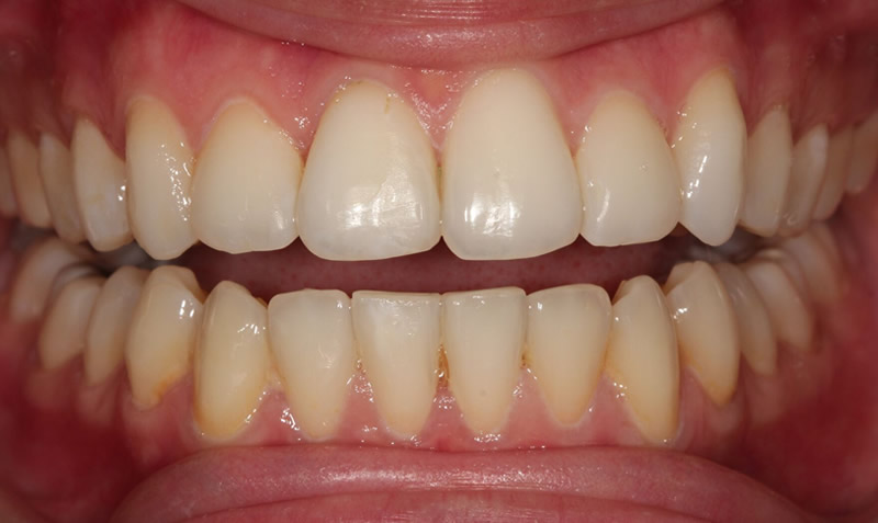 dental  whitening sachin sedani