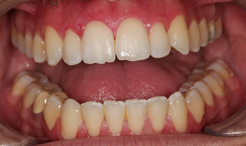 dental whitening sachin sedani