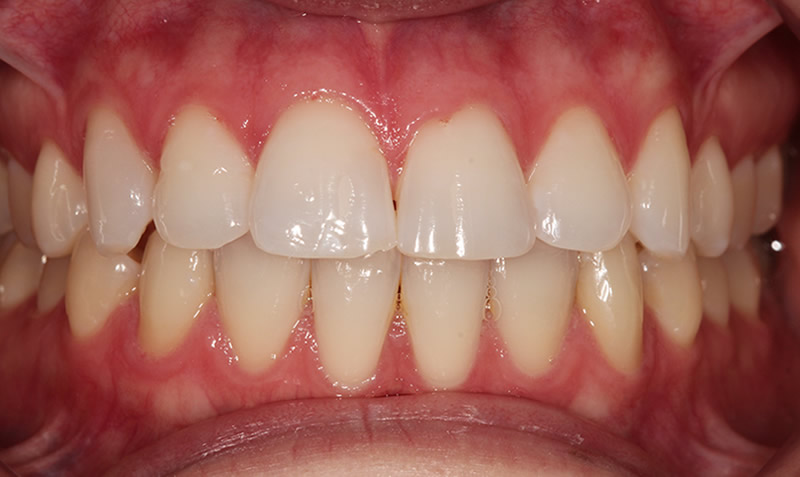dental internal whitening sachin sedani