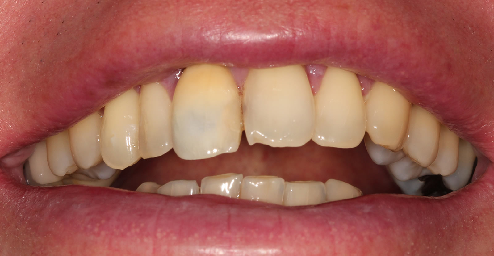 dental  whitening sachin sedani