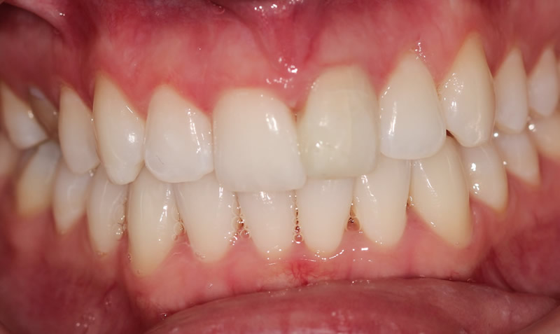 dental whitening sachin sedani