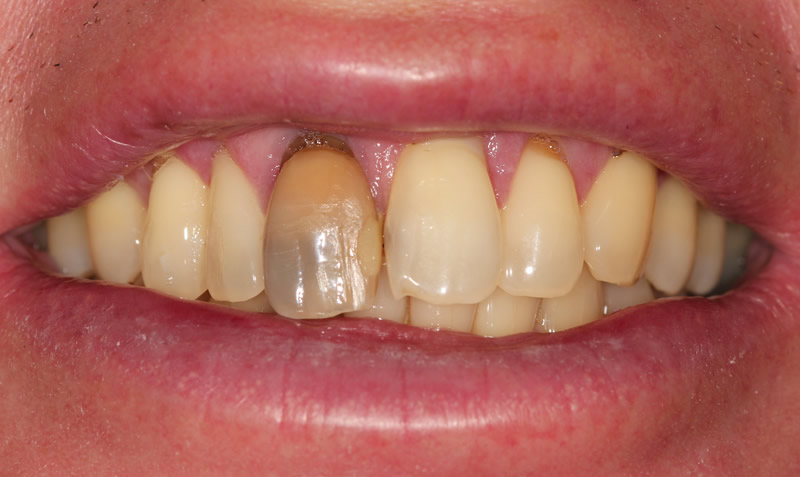 dental internal whitening