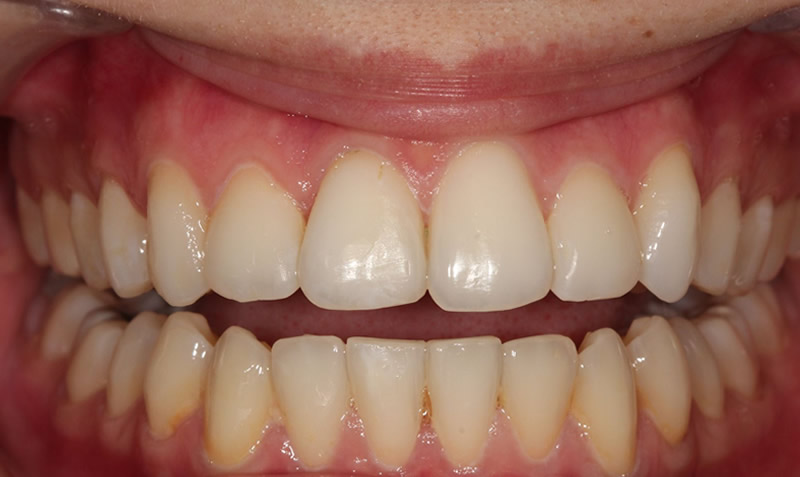 dental whitening