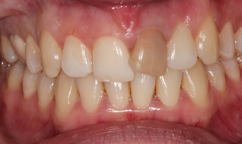 dental whitening