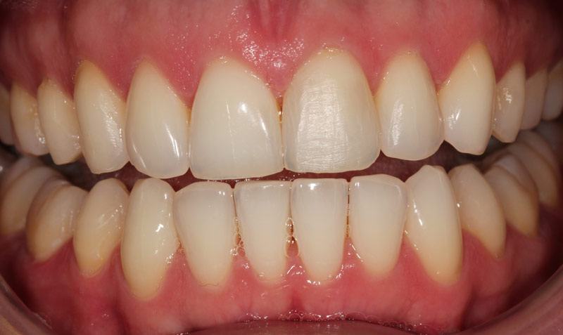 Victoria dental whitening